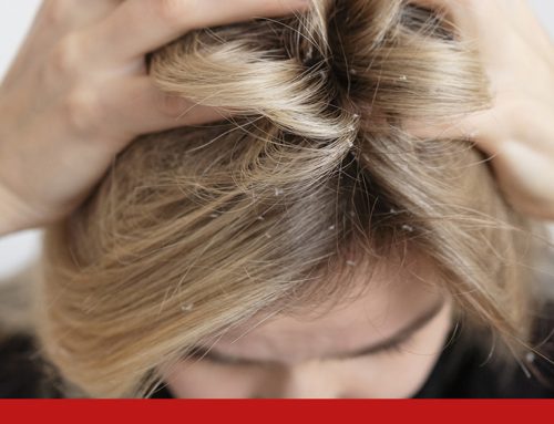 Picor en el Cuero Cabelludo: causas y remedios efectivos