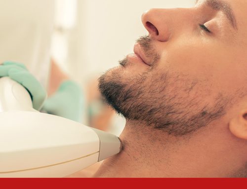 Depilación Láser para la Barba vs. Métodos Tradicionales: ¿Cuál es mejor?